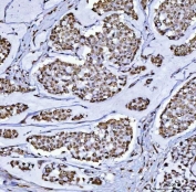 IHC staining of FFPE human breast cancer tissue with B-cell lymphoma/leukemia 11B antibody. HIER: boil tissue sections in pH8 EDTA for 20 min and allow to cool before testing.