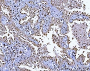 IHC staining of FFPE human lung adenocarcinoma tissue with B-cell lymphoma/leukemia 11B antibody. HIER: boil tissue sections in pH8 EDTA for 20 min and allow to cool before testing.
