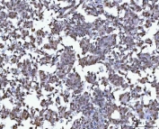 IHC staining of FFPE human ovary serous carcinoma tissue with B-cell lymphoma/leukemia 11B antibody. HIER: boil tissue sections in pH8 EDTA for 20 min and allow to cool before testing.