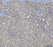 IHC staining of FFPE human bladder urothelial carcinoma with squamous differentiation tissue with B-cell lymphoma/leukemia 11B antibody. HIER: boil tissue sections in pH8 EDTA for 20 min and allow to cool before testing.