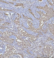 IHC staining of FFPE human lymph node metastasis carcinoma with squamous differentiation tissue with B-cell lymphoma/leukemia 11B antibody. HIER: boil tissue sections in pH8 EDTA for 20 min and allow to cool before testing.