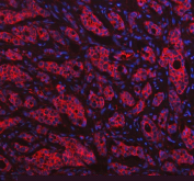 Immunofluorescent staining of FFPE human breast cancer tissue with HGPRTase antibody (red) and DAPI nuclear stain (blue). HIER: steam section in pH8 EDTA buffer for 20 min.