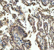 IHC staining of FFPE human lung cancer tissue with OTT1 antibody. HIER: boil tissue sections in pH8 EDTA for 20 min and allow to cool before testing.