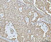 IHC staining of FFPE human lung cancer tissue with OTT1 antibody. HIER: boil tissue sections in pH8 EDTA for 20 min and allow to cool before testing.