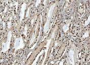 IHC staining of FFPE human prostate cancer tissue with OTT1 antibody. HIER: boil tissue sections in pH8 EDTA for 20 min and allow to cool before testing.