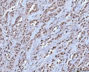 IHC staining of FFPE human breast cancer tissue with OTT1 antibody. HIER: boil tissue sections in pH8 EDTA for 20 min and allow to cool before testing.