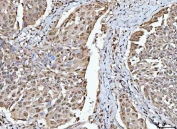 IHC staining of FFPE human esophageal squamous carcinoma tissue with OTT1 antibody. HIER: boil tissue sections in pH8 EDTA for 20 min and allow to cool before testing.