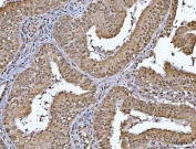 IHC staining of FFPE human endometrial carcinoma tissue with OTT1 antibody. HIER: boil tissue sections in pH8 EDTA for 20 min and allow to cool before testing.