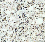 IHC staining of FFPE human endometrial carcinoma tissue with OTT1 antibody. HIER: boil tissue sections in pH8 EDTA for 20 min and allow to cool before testing.