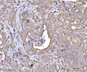 IHC staining of FFPE human colon adenocarcinoma tissue with PLD6 antibody. HIER: boil tissue sections in pH8 EDTA for 20 min and allow to cool before testing.