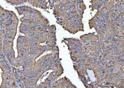 IHC staining of FFPE human endometrial adenocarcinoma tissue with PLD6 antibody. HIER: boil tissue sections in pH8 EDTA for 20 min and allow to cool before testing.