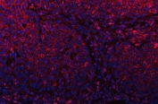 Immunofluorescent staining of FFPE human esophagus squama cancer tissue with PLD6 antibody (red) and DAPI nuclear stain (blue). HIER: steam section in pH6 citrate buffer for 20 min.