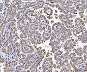 IHC staining of FFPE human lung cancer tissue with GRIM19 antibody. HIER: boil tissue sections in pH8 EDTA for 20 min and allow to cool before testing.