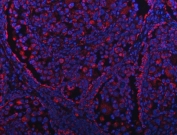 Immunofluorescent staining of FFPE human lung cancer tissue with GRIM19 antibody (red) and DAPI nuclear stain (blue). HIER: steam section in pH8 EDTA buffer for 20 min.