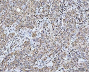 IHC staining of FFPE human squamous cell carcinoma of the skin with GRIM19 antibody. HIER: boil tissue sections in pH8 EDTA for 20 min and allow to cool before testing.