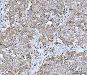 IHC staining of FFPE human urothelial carcinoma with squamous differentiation with GRIM19 antibody. HIER: boil tissue sections in pH8 EDTA for 20 min and allow to cool before testing.