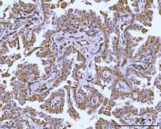 IHC staining of FFPE human lung adenocarcinoma tissue with HRPAP20 antibody. HIER: boil tissue sections in pH8 EDTA for 20 min and allow to cool before testing.