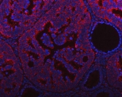 Immunofluorescent staining of FFPE human intestinal cancer tissue with HRPAP20 antibody (red) and DAPI nuclear stain (blue). HIER: steam section in pH8 EDTA buffer for 20 min.