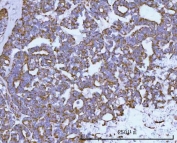 IHC staining of FFPE human ovarian tumor tissue with HRPAP20 antibody. HIER: boil tissue sections in pH8 EDTA for 20 min and allow to cool before testing.