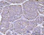 IHC staining of FFPE human liver cancer tissue with HRPAP20 antibody. HIER: boil tissue sections in pH8 EDTA for 20 min and allow to cool before testing.