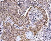IHC staining of FFPE human lung cancer tissue with MAFF antibody. HIER: boil tissue sections in pH8 EDTA for 20 min and allow to cool before testing.