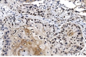 IHC staining of FFPE human esophageal squamous carcinoma tissue with MAFF antibody. HIER: boil tissue sections in pH8 EDTA for 20 min and allow to cool before testing.