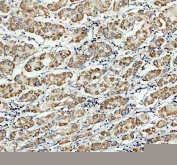 IHC staining of FFPE human liver cancer tissue with NDUFB7 antibody. HIER: boil tissue sections in pH8 EDTA for 20 min and allow to cool before testing.