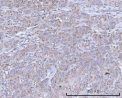 IHC staining of FFPE human skin squamous carcinoma tissue with NDUFB7 antibody. HIER: boil tissue sections in pH8 EDTA for 20 min and allow to cool before testing.
