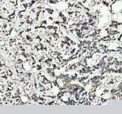 IHC staining of FFPE human breast cancer tissue with NDUFB7 antibody. HIER: boil tissue sections in pH8 EDTA for 20 min and allow to cool before testing.