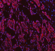 Immunofluorescent staining of FFPE human breast cancer tissue with NDUFB7 antibody (red) and DAPI nuclear stain (blue). HIER: steam section in pH6 citrate buffer for 20 min.