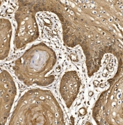 IHC staining of FFPE human esophageal squamous carcinoma tissue with Eukaryotic translation initiation factor 5 antibody. HIER: boil tissue sections in pH8 EDTA for 20 min and allow to cool before testing.