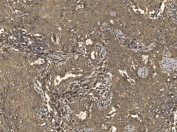 IHC staining of FFPE human lung cancer tissue with Eukaryotic translation initiation factor 5 antibody. HIER: boil tissue sections in pH8 EDTA for 20 min and allow to cool before testing.