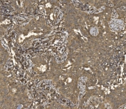 IHC staining of FFPE human lung cancer tissue with Eukaryotic translation initiation factor 5 antibody. HIER: boil tissue sections in pH8 EDTA for 20 min and allow to cool before testing.