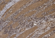 IHC staining of FFPE human gastric cancer tissue with Eukaryotic translation initiation factor 5 antibody. HIER: boil tissue sections in pH8 EDTA for 20 min and allow to cool before testing.