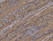 IHC staining of FFPE human gastric cancer tissue with Eukaryotic translation initiation factor 5 antibody. HIER: boil tissue sections in pH8 EDTA for 20 min and allow to cool before testing.