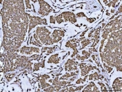 IHC staining of FFPE human breast cancer with PP-X antibody. HIER: boil tissue sections in pH8 EDTA for 20 min and allow to cool before testing.