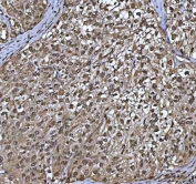 IHC staining of FFPE human invasive urothelial carcinoma of the bladder with squamous differentiation tissue with PP-X antibody. HIER: boil tissue sections in pH8 EDTA for 20 min and allow to cool before testing.