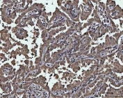 IHC staining of FFPE human lung cancer tissue with PP-X antibody. HIER: boil tissue sections in pH8 EDTA for 20 min and allow to cool before testing.