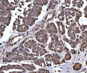 IHC staining of FFPE human ovarian serous adenocarcinoma tissue with PP-X antibody. HIER: boil tissue sections in pH8 EDTA for 20 min and allow to cool before testing.