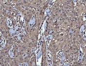 IHC staining of FFPE human skin squamous cell carcinoma tissue with PP-X antibody. HIER: boil tissue sections in pH8 EDTA for 20 min and allow to cool before testing.