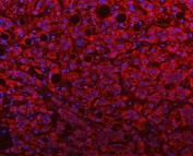 Immunofluorescent staining of FFPE human liver cancer with PGP antibody (red) and DAPI nuclear stain (blue). HIER: steam section in pH8 EDTA buffer for 20 min.