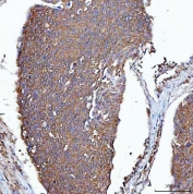 IHC staining of FFPE human esophageal squamous carcinoma tissue with PGP antibody. HIER: boil tissue sections in pH8 EDTA for 20 min and allow to cool before testing.