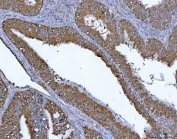IHC staining of FFPE human endometrial adenocarcinoma tissue with PGP antibody. HIER: boil tissue sections in pH8 EDTA for 20 min and allow to cool before testing.