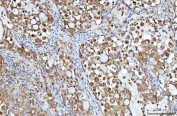 IHC staining of FFPE human lung cancer tissue with PGP antibody. HIER: boil tissue sections in pH8 EDTA for 20 min and allow to cool before testing.