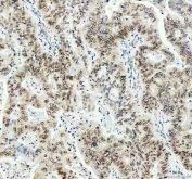 IHC staining of FFPE human stomach cancer tissue with PPP2R5D antibody. HIER: boil tissue sections in pH8 EDTA for 20 min and allow to cool before testing.