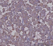 IHC staining of FFPE human lung adenocarcinoma tissue with Serpin A8 antibody. HIER: boil tissue sections in pH8 EDTA for 20 min and allow to cool before testing.