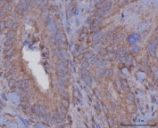 IHC staining of FFPE human rectum adenocarcinoma tissue with Serpin A8 antibody. HIER: boil tissue sections in pH8 EDTA for 20 min and allow to cool before testing.