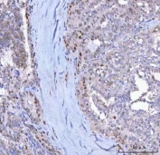 IHC staining of FFPE human thyroid cancer tissue with CDKN1A antibody. HIER: boil tissue sections in pH8 EDTA for 20 min and allow to cool before testing.