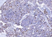 IHC staining of FFPE human ovarian cancer tissue with CDKN1A antibody. HIER: boil tissue sections in pH8 EDTA for 20 min and allow to cool before testing.
