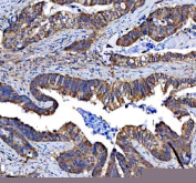 IHC staining of FFPE human colon cancer tissue with Ephrin Receptor B3 antibody, HRP-secondary and DAB substrate. HIER: boil tissue sections in pH8 EDTA for 20 min and allow to cool before testing.